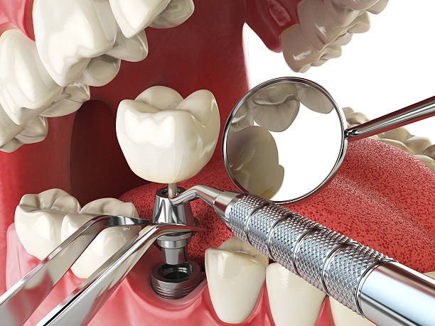 Best Emergency Root Canal Treatment in Boulevard Park, WA